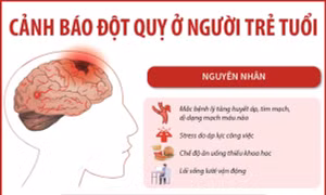 Cảnh báo đột quỵ ở người trẻ tuổi