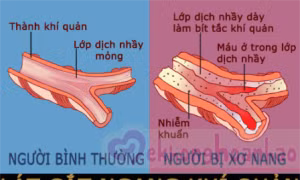 Bỉ đạt được bước đột phá trong cuộc chiến chống lại bệnh xơ nang