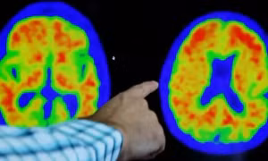 Hình ảnh não của bệnh nhân Alzheimer khi chụp PET. Ảnh: Reuters