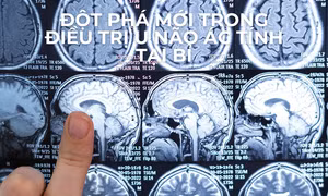 Đột phá mới trong điều trị u não ác tính tại Bỉ