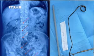 Hy hữu ông lão 82 tuổi có ống sonde JJ dài hơn 20 cm “ngủ quên” cả năm trong bàng quang