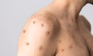 Virus đậu mùa khỉ tiến hóa, nguy cơ lây lan giữa người tăng cao