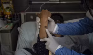 Bệnh nhân đậu mùa khỉ có thể truyền virus trước khi xuất hiện triệu chứng bệnh