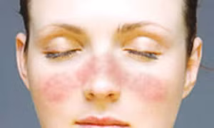 Phát hiện gene gây bệnh lupus ban đỏ