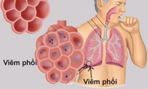 Phương pháp xét nghiệm mới giúp đánh giá mức độ nghiêm trọng của bệnh phổi hiếm gặp