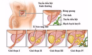 Kết hợp AI với hình ảnh mô 3D để xác định ung thư tuyến tiền liệt