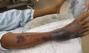 Cảnh báo nguy cơ hoại tử bàn chân do nhiễm vi khuẩn Vibrio vulnificus