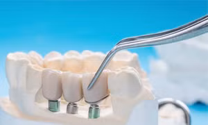 Bước tiến mới trong phát triển vật liệu nha khoa