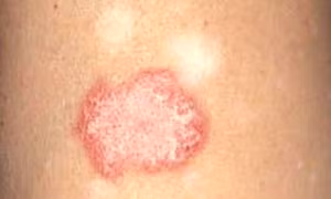 Tìm ra phương pháp mới điều trị lupus ban đỏ