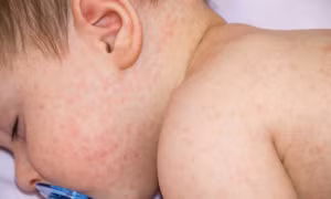 Phát hiện mới về việc ngăn ngừa nguy cơ dị ứng ở trẻ em