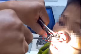 Gắp thành công con vắt dài 8cm trong mũi một thiếu niên
