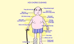 Điều trị thành công ca bệnh mắc Hội chứng Cushing với nhiều biến chứng nặng