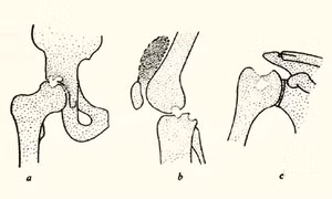Bệnh lao xương khớp: Xin đừng chủ quan