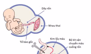 Máu dây rốn được thu thập từ dây rốn đã cắt khỏi em bé và lưu trữ trong túi chuyên dụng. Nguồn: buudienhospital.vn 
