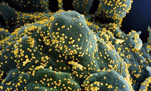 Hình ảnh quét qua kính hiển vi điện tử cho thấy một tế bào (màu xanh) bị virus SARS-COV-2 (màu vàng) xâm nhập, lấy từ mẫu bệnh phẩm của bệnh nhân COVID-19 tại Viện Nghiên cứu Dị ứng và Bệnh Truyền nhiễm Quốc gia, Fort Detrick, Maryland, Mỹ ngày 15/7/2020.