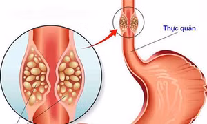 Trung Quốc phát triển mô hình chẩn đoán ung thư thực quản có độ chính xác cao