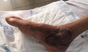 Suýt mất chân do tự điều trị bằng thuốc nam tại nhà