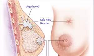 Phát hiện một loại tế bào miễn dịch mới mở ra hy vọng điều trị ung thư vú ​