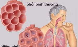 Bộ Y tế khuyến cáo về phòng chống viêm phổi cấp do chủng vi rút mới tại Trung Quốc