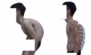 Nắn chỉnh biến dạng cột sống thành công cho bệnh nhân “siêu gù”
