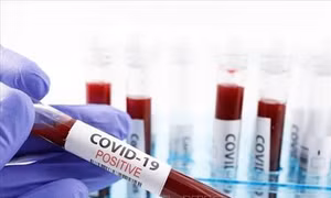 Mỹ đạt bước tiến mới trong phát hiện kháng thể chống virus SARS-CoV-2