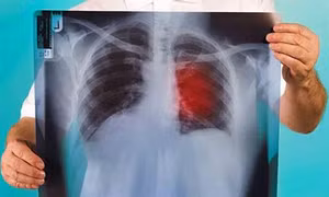 Israel phát triển phương pháp mới chữa trị ung thư
