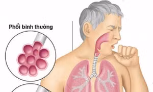 Việt Nam có số bệnh nhân mắc nấm phổi xâm lấn cao nhất thế giới