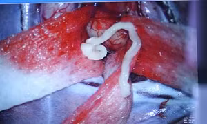 Sán nhái dài 7cm nằm trong não của người đàn ông