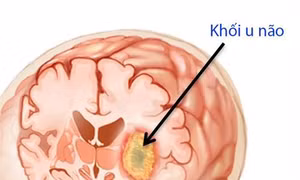 Israel phát triển phương pháp đột phá giúp điều trị ung thư não ác tính​