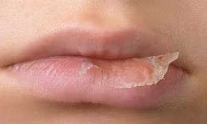 Cách giúp môi không bị nẻ khi trời khô hanh