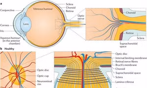 Xác định các chuỗi ADN gây bệnh bệnh tăng nhãn áp