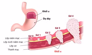 Ung thư dạ dày có thể chữa khỏi nếu phát hiện sớm