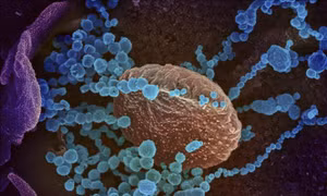 Virus SARS-CoV-2 (màu xanh) trên bề mặt các tế bào lấy từ mẫu bệnh phẩm của một bệnh nhân nhiễm COVID-2 tại Mỹ. Ảnh: AFP/TTXVN