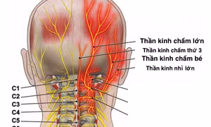 Đau dây thần kinh chẩm là một nguyên nhân phổ biến gây đau đầu. Ảnh : vinmec.com 