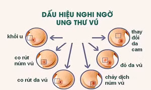 Ung thư vú là nguyên nhân gây tử vong hàng đầu do ung thư ở phụ nữ với 1,7 triệu người mắc và nửa triệu người chết hàng năm. Ảnh :benhvien108.vn 