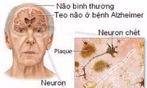Alzheimer là bệnh mất trí nhớ dần dần, hay xuất hiện ở người lớn tuổi. Ảnh : suckhoedoisong.vn 