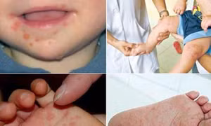 Đồng Tháp: Khuyến cáo các biện pháp phòng ngừa bệnh tay chân miệng