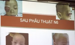 Cấp cứu kịp thời bé trai viêm xoang gây biến chứng áp xe mắt khổng lồ