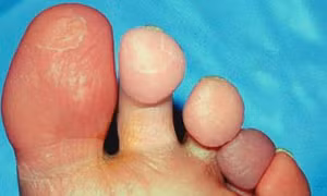 Raynaud - Chứng bệnh xuất hiện khi trời lạnh