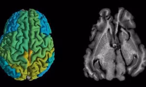 Kỹ thuật MRI mới giúp sớm phát hiện các căn bệnh thoái hóa thần kinh