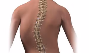 Lựa chọn phương pháp hữu hiệu điều trị bệnh cong vẹo cột sống