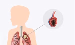 Phương pháp tầm soát ung thư phổi chỉ cần xét nghiệm máu đơn giản