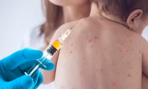 Thêm một phát hiện mới về tác hại của bệnh sởi