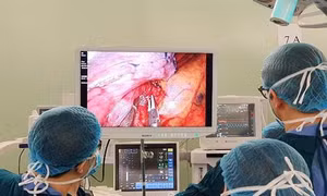 Lần đầu tiên triển khai thành công kỹ thuật cắt thùy phổi nội soi một đường rạch