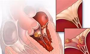 Viêm cơ tim vẫn có thể ngăn ngừa