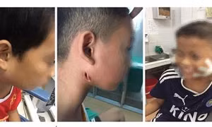 Nghệ An điều trị ba ca bệnh mắc chứng bệnh vi khuẩn ăn thịt người