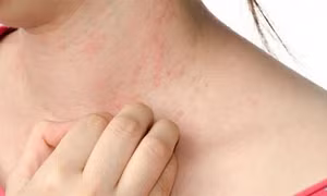 Nghiên cứu về phương pháp chữa trị bệnh phát ban đỏ