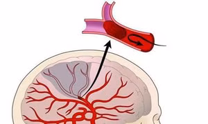 Đột quỵ não vì tập luyện, điều trị bệnh theo phương pháp không có cơ sở khoa học