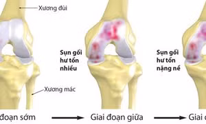 Giải pháp điều trị cho người bệnh thoái hóa khớp gối nặng