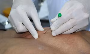 Thủy châm: Phương pháp điều trị kết hợp y học hiện đại và y học cổ truyền